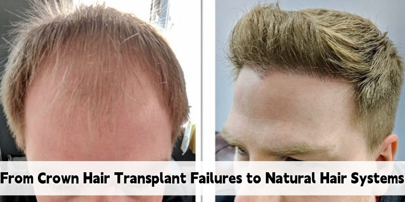 From Crown Hair Transplant Failures to Natural Hair Systems: A Better Path to Full Coverage
