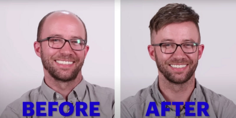 Understanding Hair Replacement Surgery Alternatives: Why Choose Hair Systems?