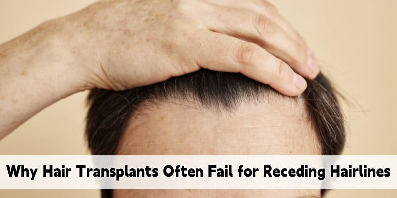 Transplants for Receding Hairlines? Why They Often Fall Short