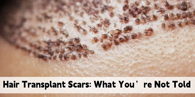 Scalp Scars and Regret: When Hair Transplants Leave a Mark—Literally