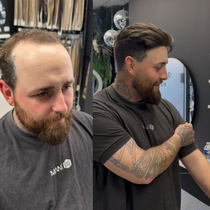 Q6 base Men's Non Surgical Hair Replacement | Swiss Lace With Skin Poly Back and Middle| Best for Daily Wear