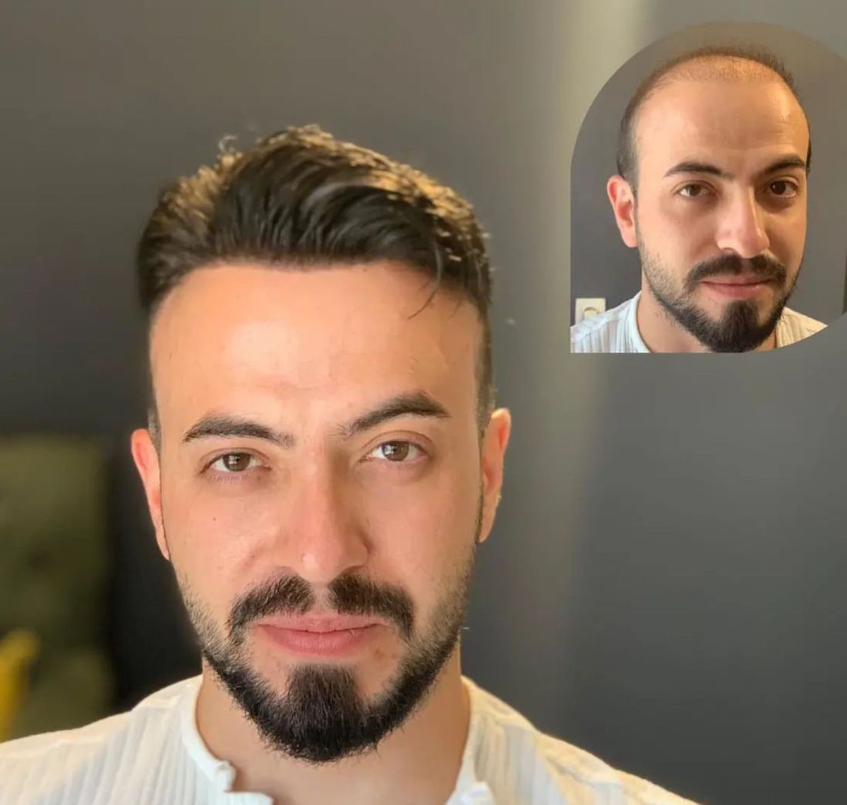 Hollywood Base Hair System for Men | Full Lace in Center with 1'' Thin Skin Around and 1/2'' Lace in the Front | Hollywood Style